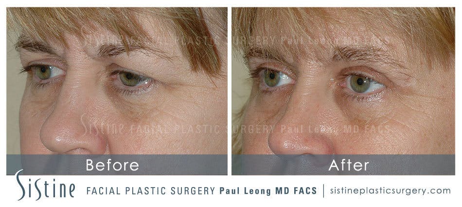 Eyes Before and After | Leong Facial Plastic Surgery