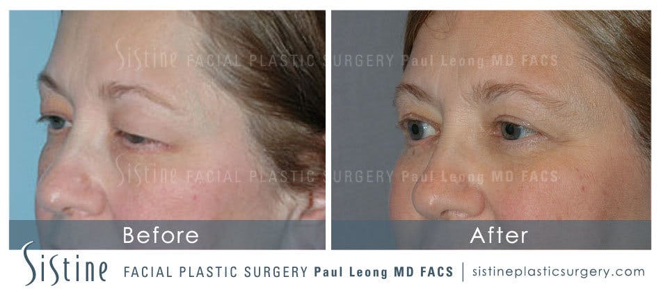 Eyes Before and After | Leong Facial Plastic Surgery