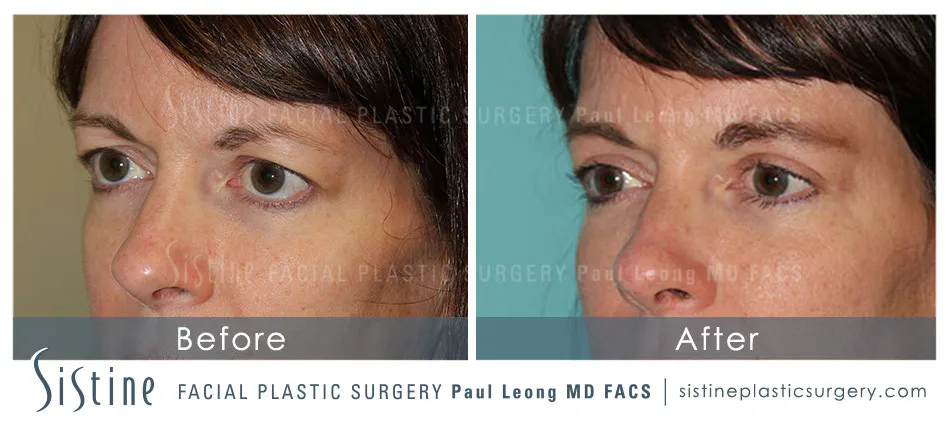 Eyes Before and After | Leong Facial Plastic Surgery