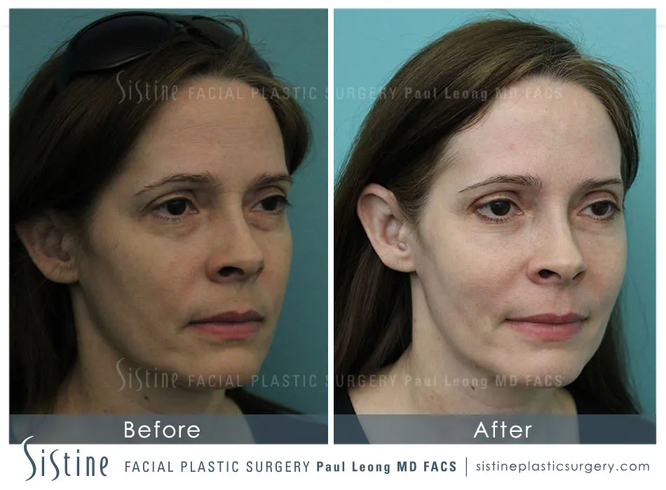 Eyes Before and After | Leong Facial Plastic Surgery