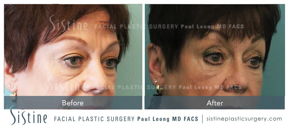 Restylane Dermal Fillers for Tear Trough - Before Treatment | Dr. Paul Leong, Pittsburgh PA