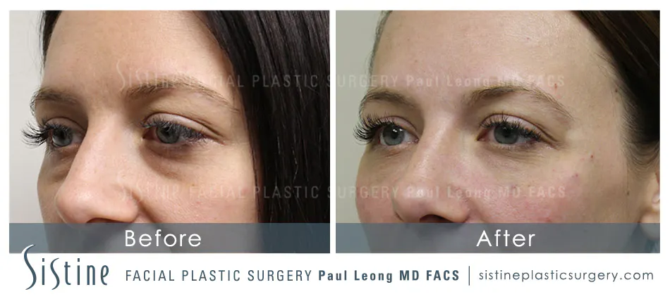 Eyes Before and After | Leong Facial Plastic Surgery