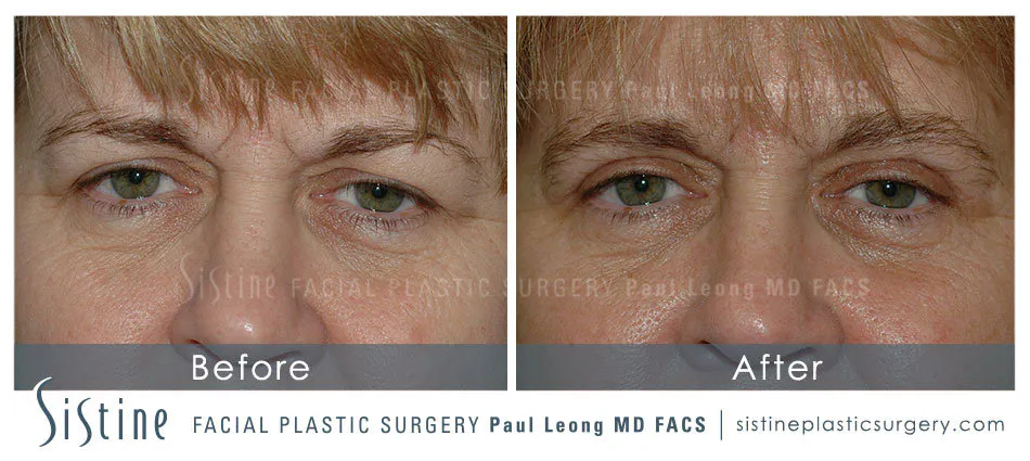 Eyes Before and After | Leong Facial Plastic Surgery