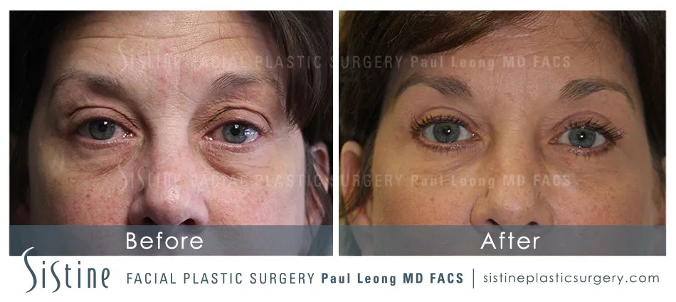Eyes Before and After | Leong Facial Plastic Surgery