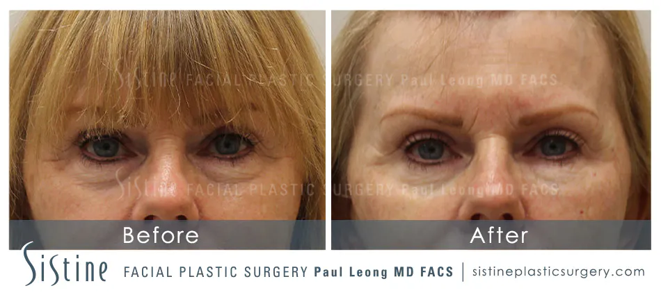 Eyes Before and After | Leong Facial Plastic Surgery