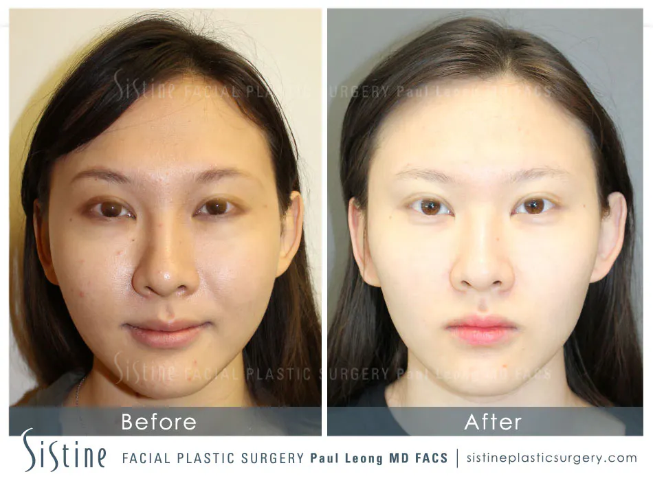 Non-Surgical Under Eye Treatment - Before Image | Paul Leong MD, Pittsburgh Southside Works