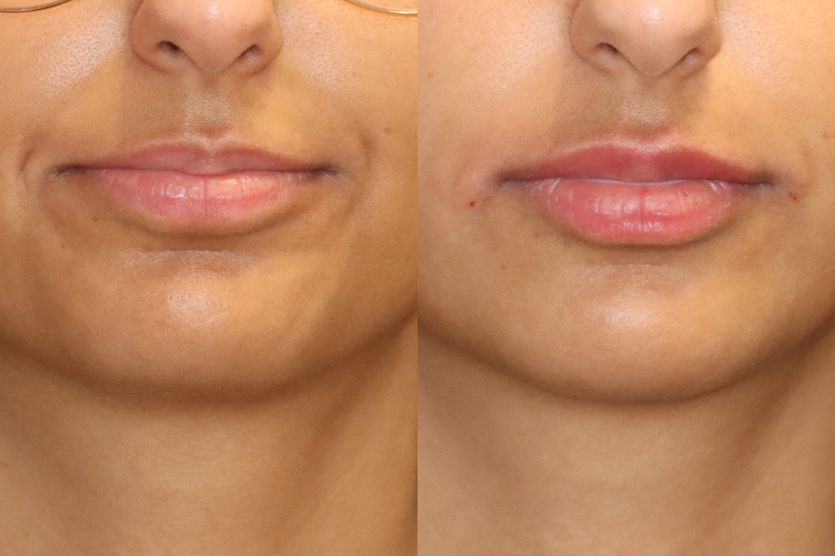 Lips Before and After | Leong Facial Plastic Surgery