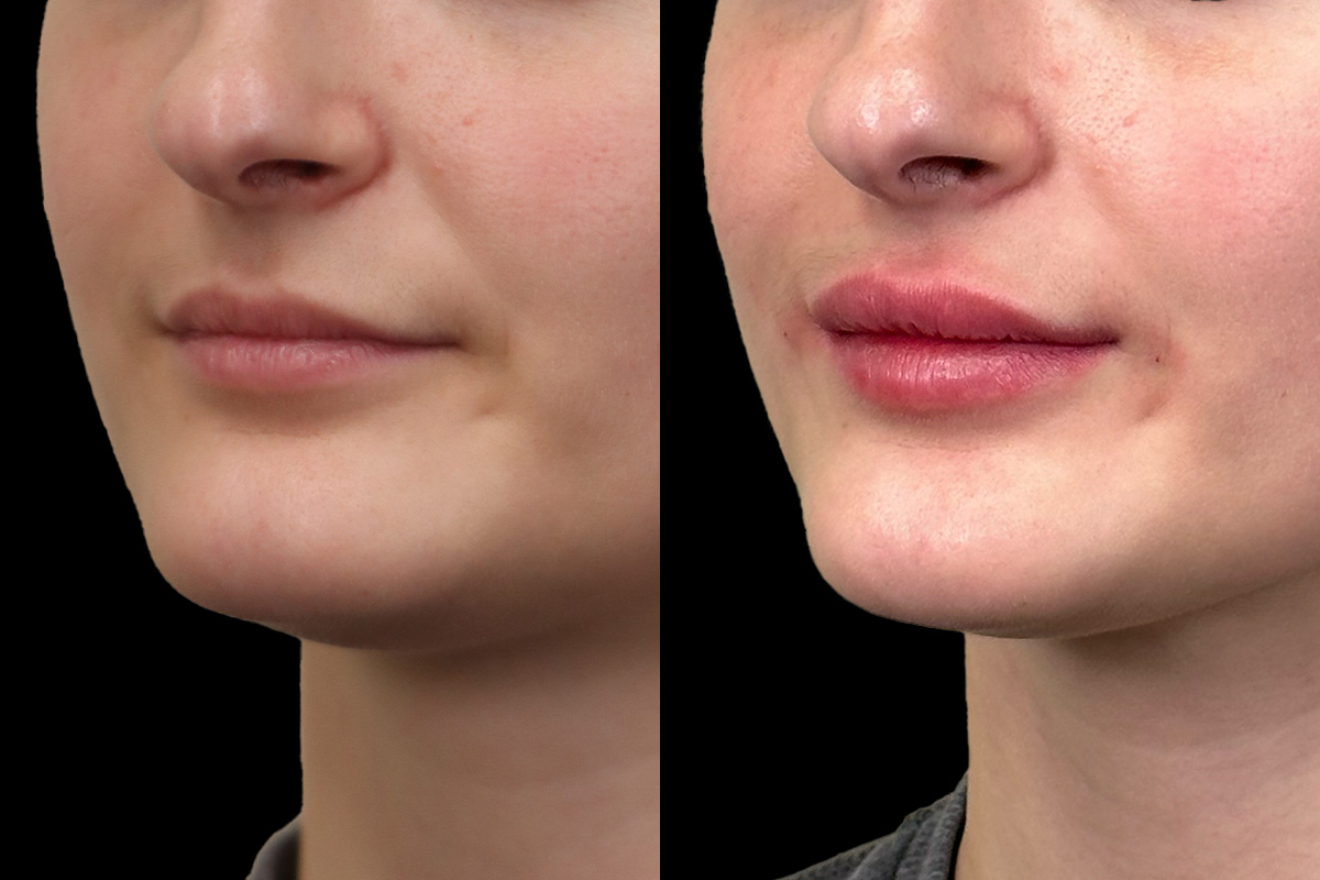 Lips Before and After | Leong Facial Plastic Surgery