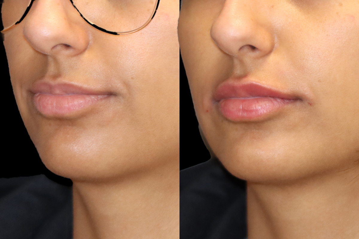Lips Before and After | Leong Facial Plastic Surgery