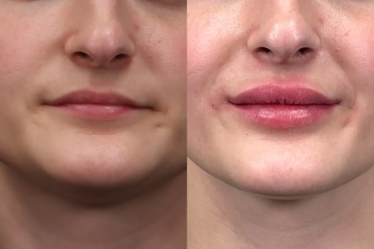 Lips Before and After | Leong Facial Plastic Surgery
