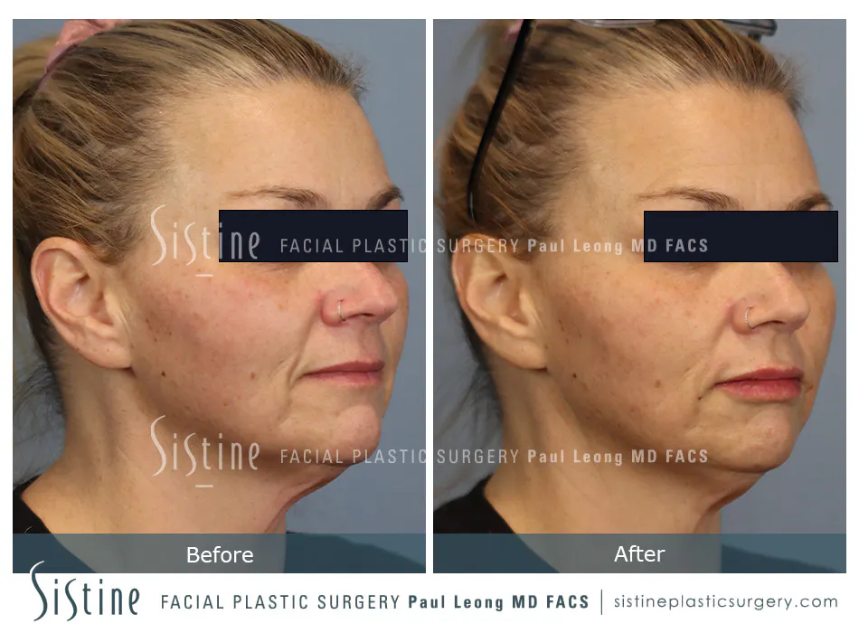 Lips Before and After | Leong Facial Plastic Surgery