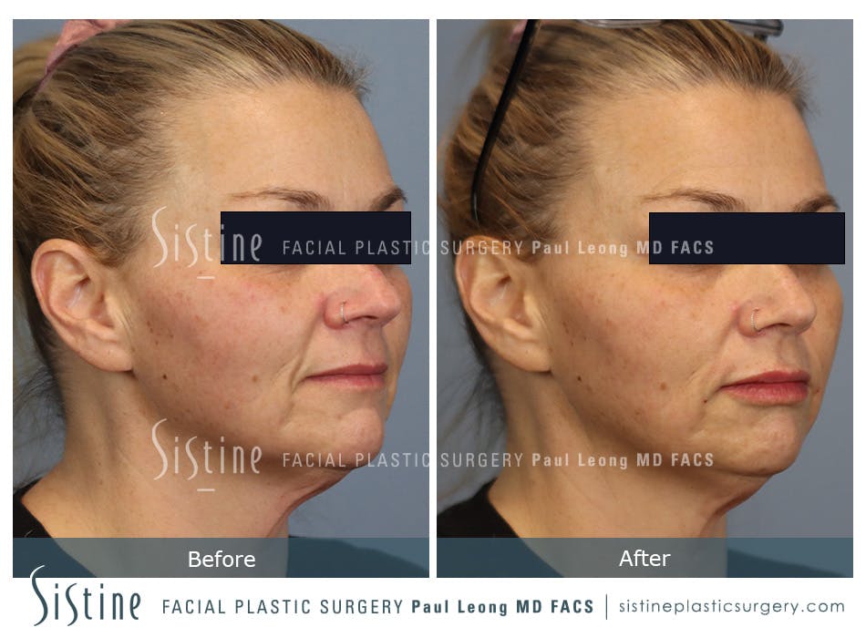 Lips Before and After | Leong Facial Plastic Surgery