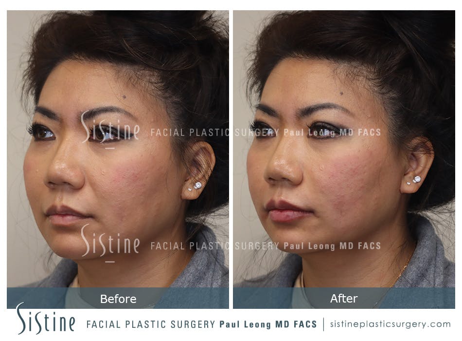 Lips Before and After | Leong Facial Plastic Surgery