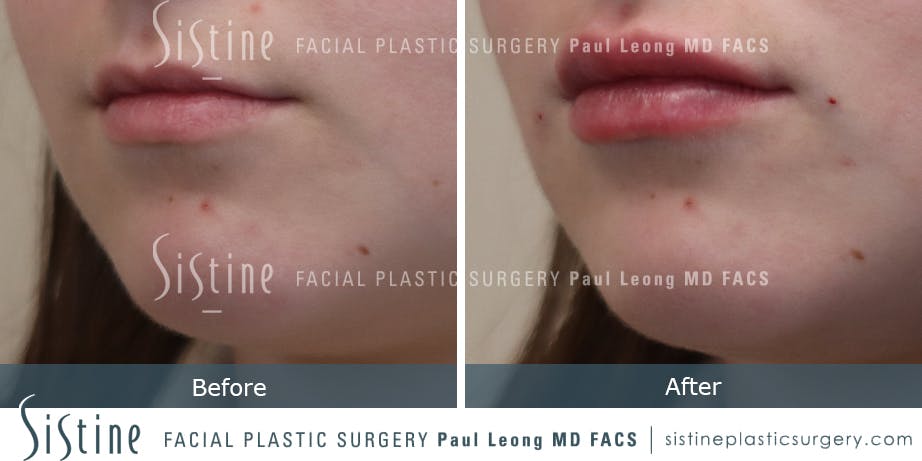 Lips Before and After | Leong Facial Plastic Surgery