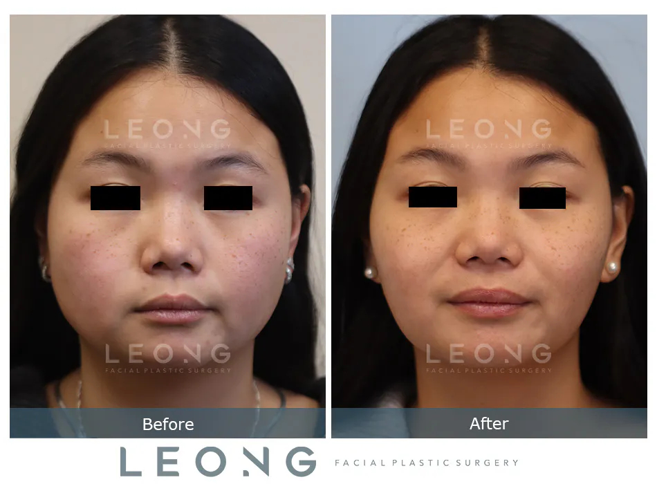Masseter Before and After | Leong Facial Plastic Surgery