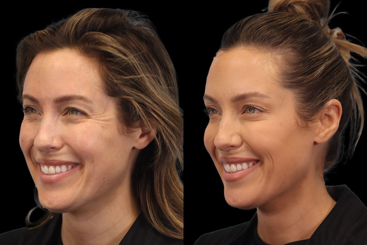 Masseter Before and After | Leong Facial Plastic Surgery