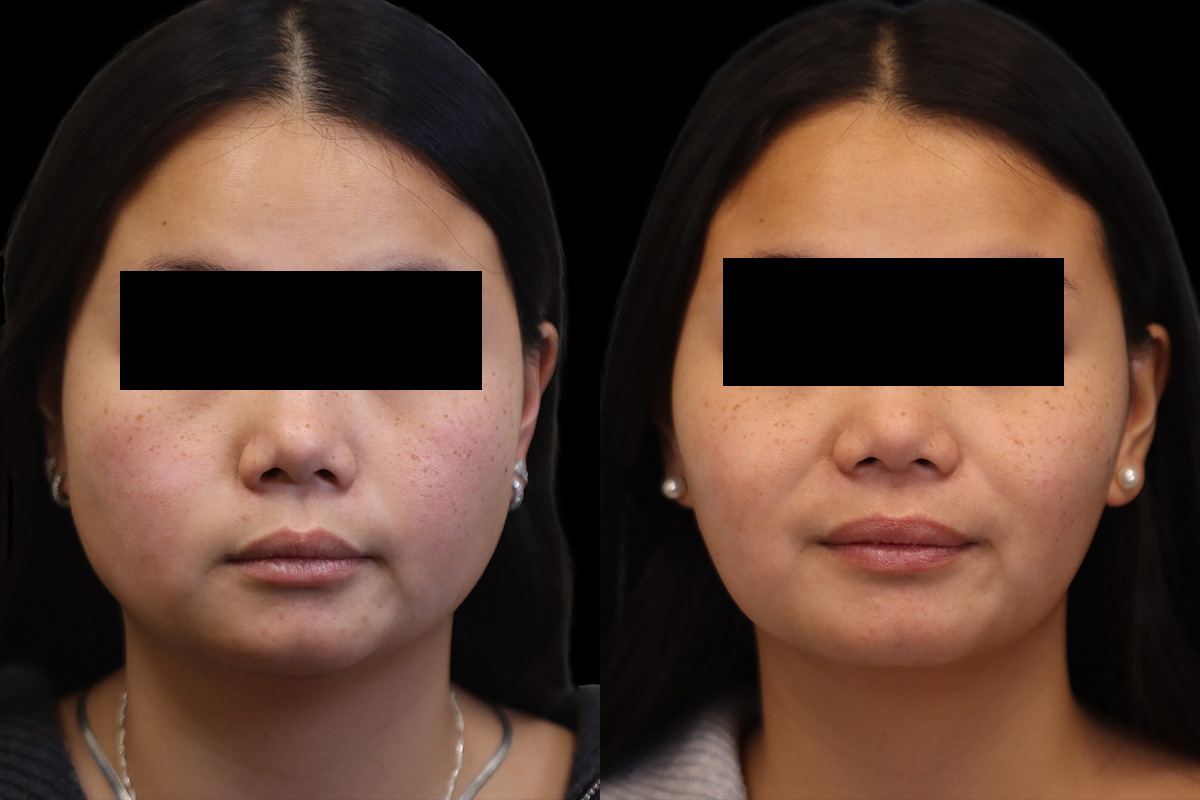 Masseter Before and After | Leong Facial Plastic Surgery