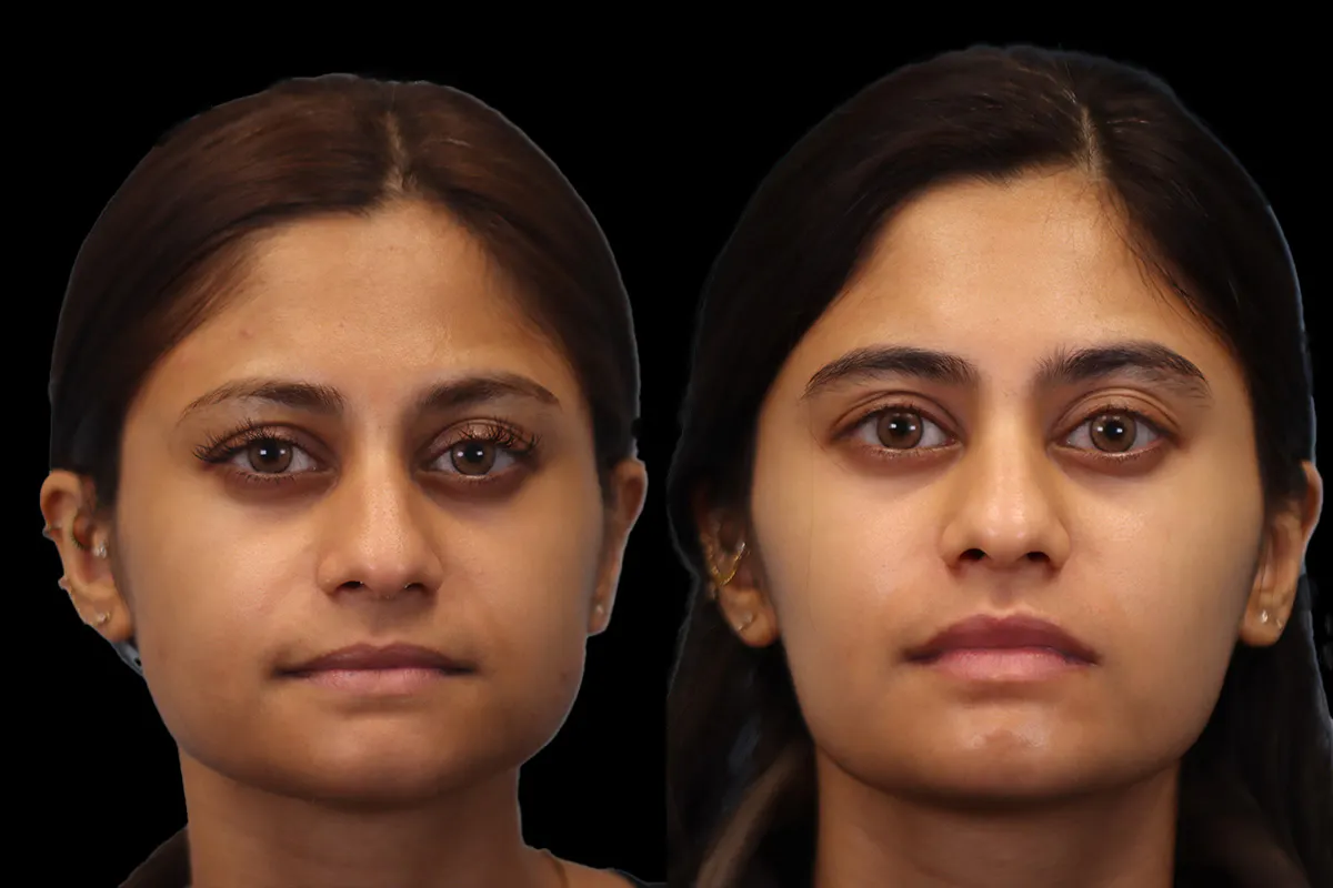 Masseter Before and After | Leong Facial Plastic Surgery
