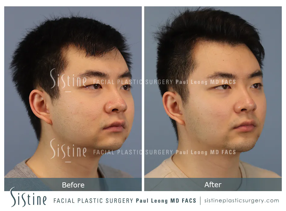 Masseter Before and After | Leong Facial Plastic Surgery