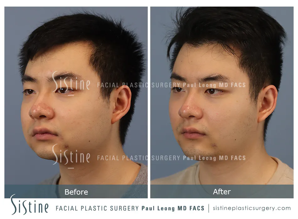 Masseter Before and After | Leong Facial Plastic Surgery