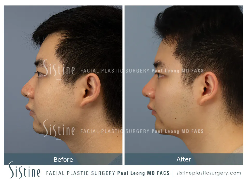 Masseter Before and After | Leong Facial Plastic Surgery