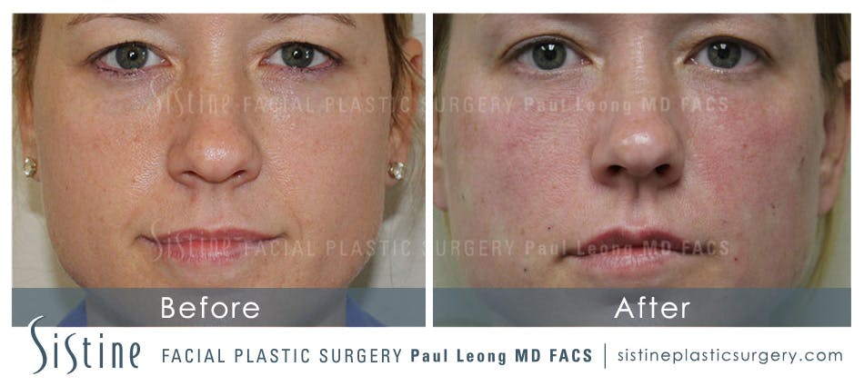 Nasolabial Folds Before and After | Leong Facial Plastic Surgery