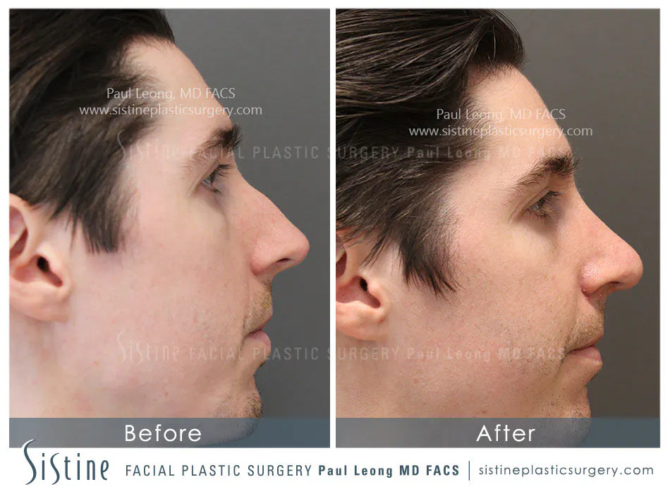 Nose Before and After | Leong Facial Plastic Surgery