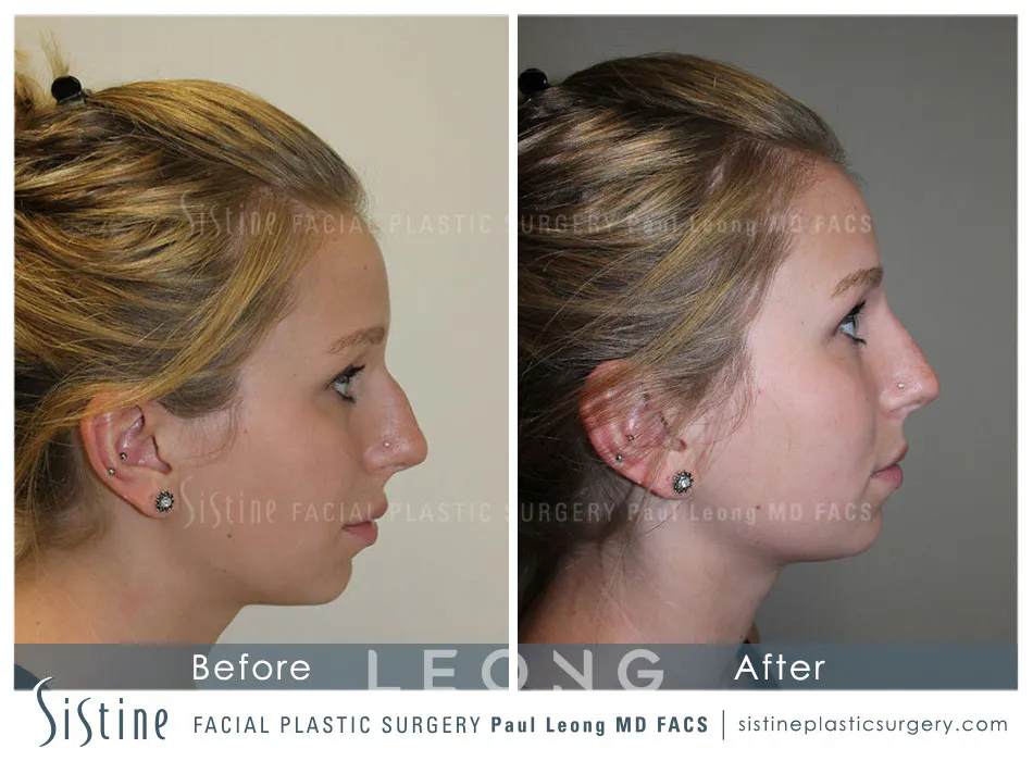 Nose Before and After | Leong Facial Plastic Surgery