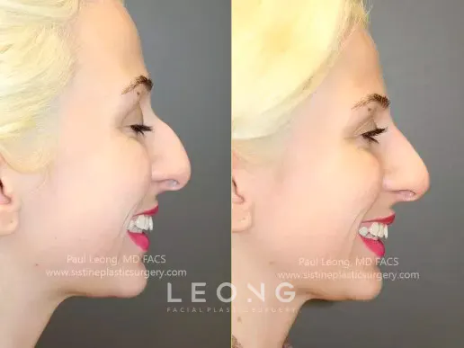 Nose Before and After | Leong Facial Plastic Surgery