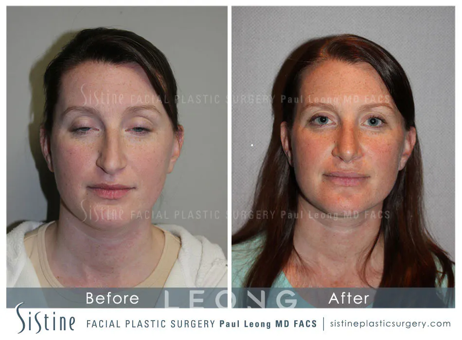Nose Before and After | Leong Facial Plastic Surgery