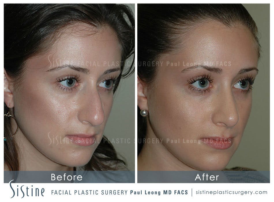 Nose Before and After | Leong Facial Plastic Surgery