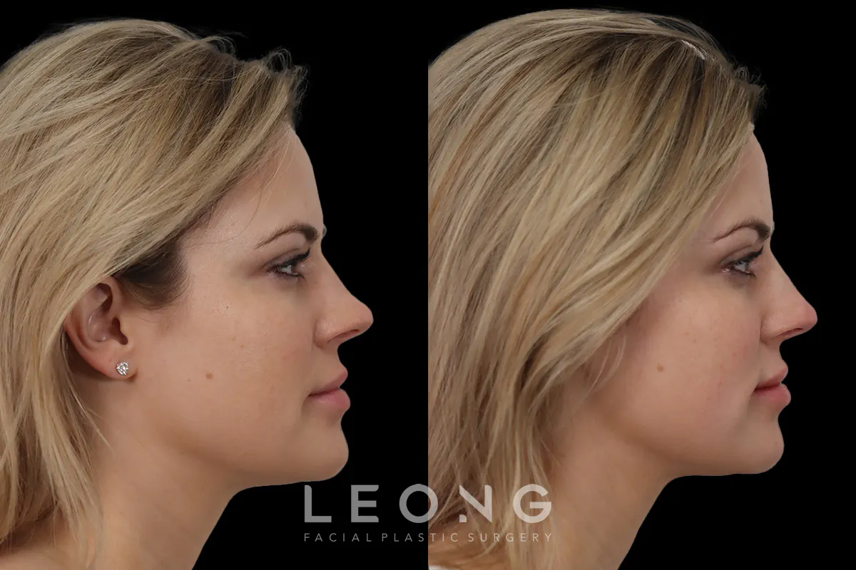 Nose Before and After | Leong Facial Plastic Surgery