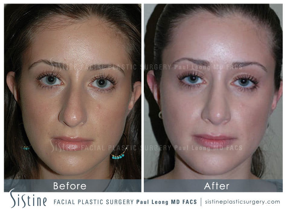Nose Before and After | Leong Facial Plastic Surgery