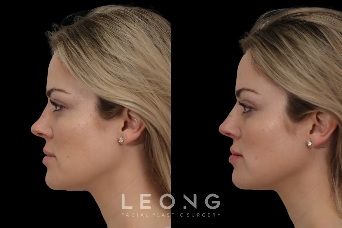 Nose Before and After | Leong Facial Plastic Surgery