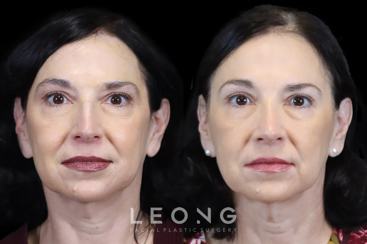 Nose Before and After | Leong Facial Plastic Surgery