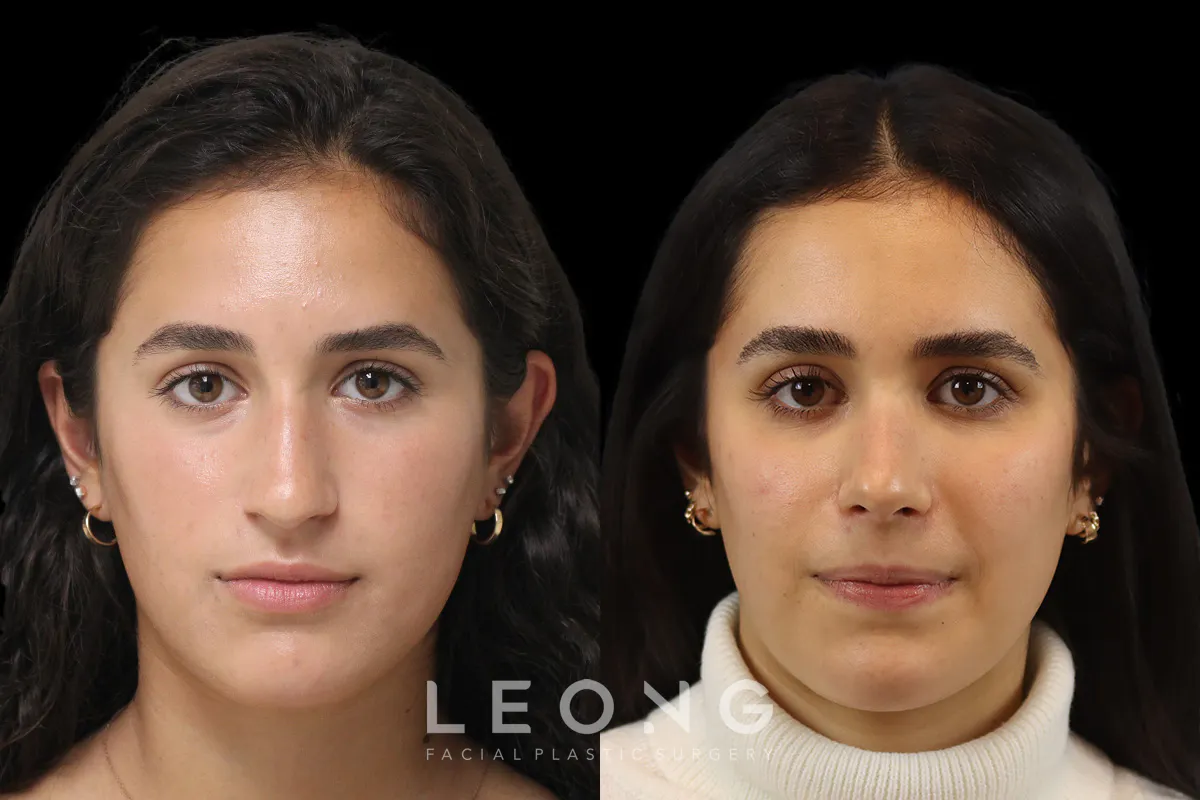 Nose Before and After | Leong Facial Plastic Surgery