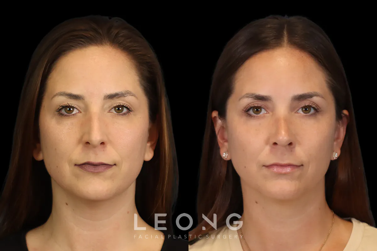 Nose Before and After | Leong Facial Plastic Surgery