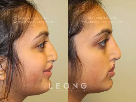 Nose Before and After | Leong Facial Plastic Surgery