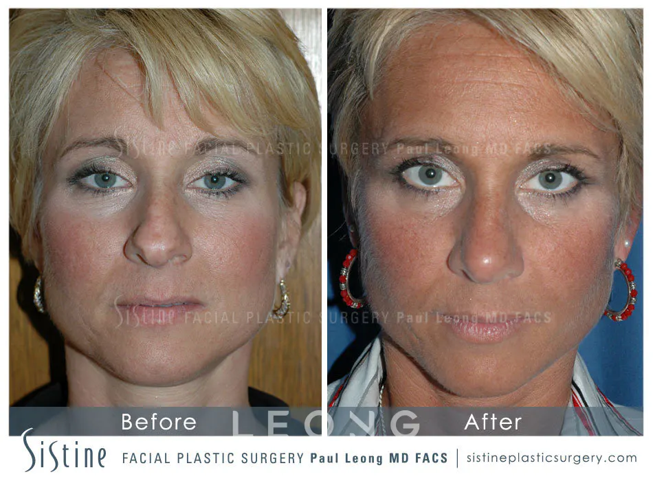Nose Before and After | Leong Facial Plastic Surgery