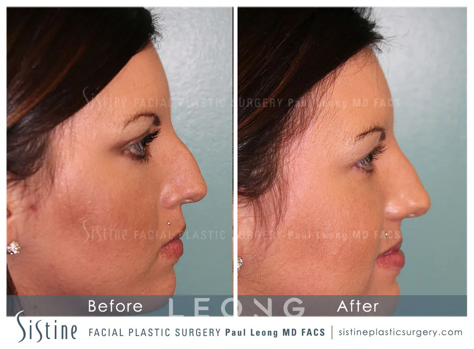 Nose Before and After | Leong Facial Plastic Surgery