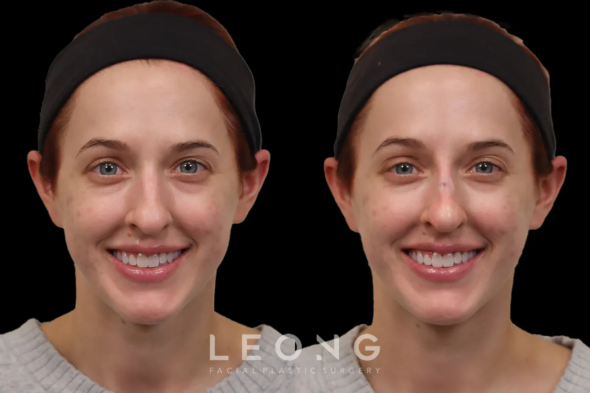 Nose Before and After | Leong Facial Plastic Surgery