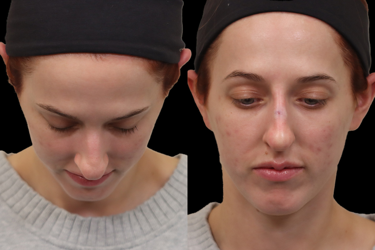Nose Before and After | Leong Facial Plastic Surgery