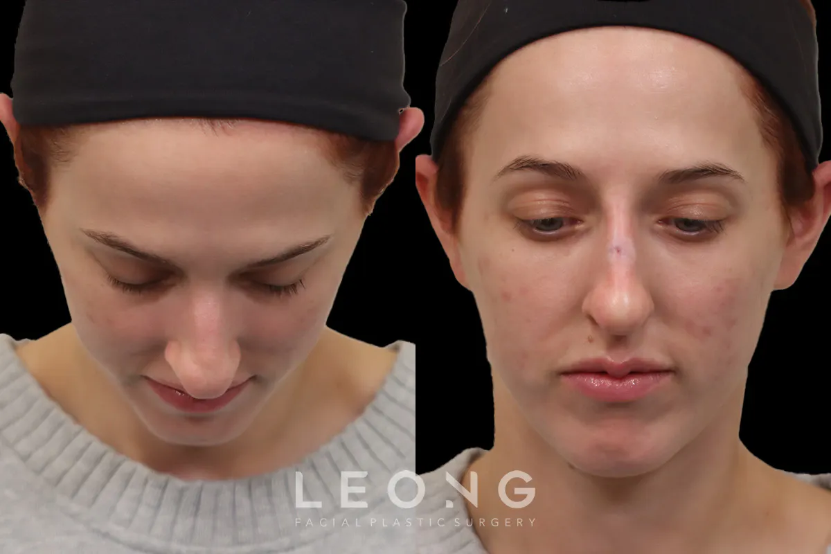 Nose Before and After | Leong Facial Plastic Surgery
