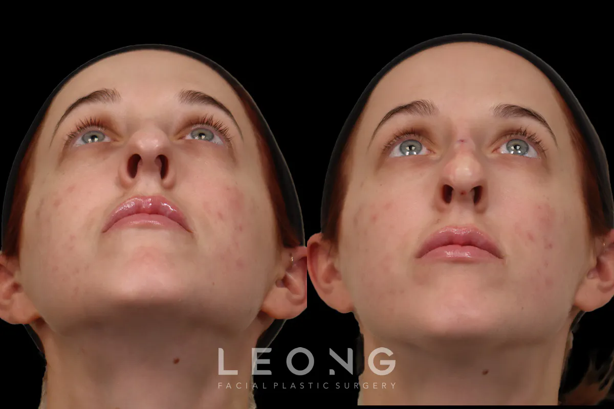 Nose Before and After | Leong Facial Plastic Surgery