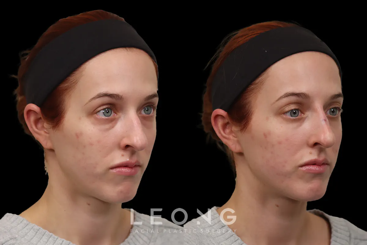 Nose Before and After | Leong Facial Plastic Surgery