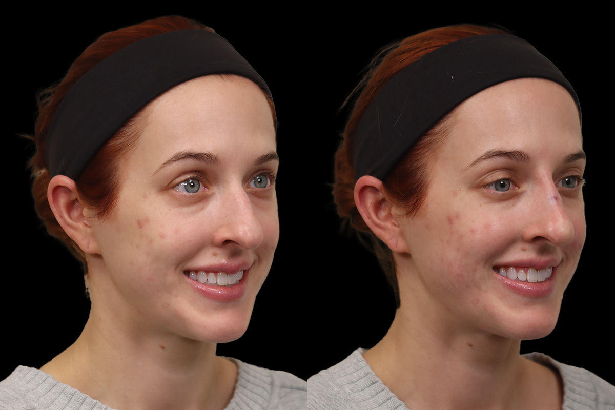 Nose Before and After | Leong Facial Plastic Surgery