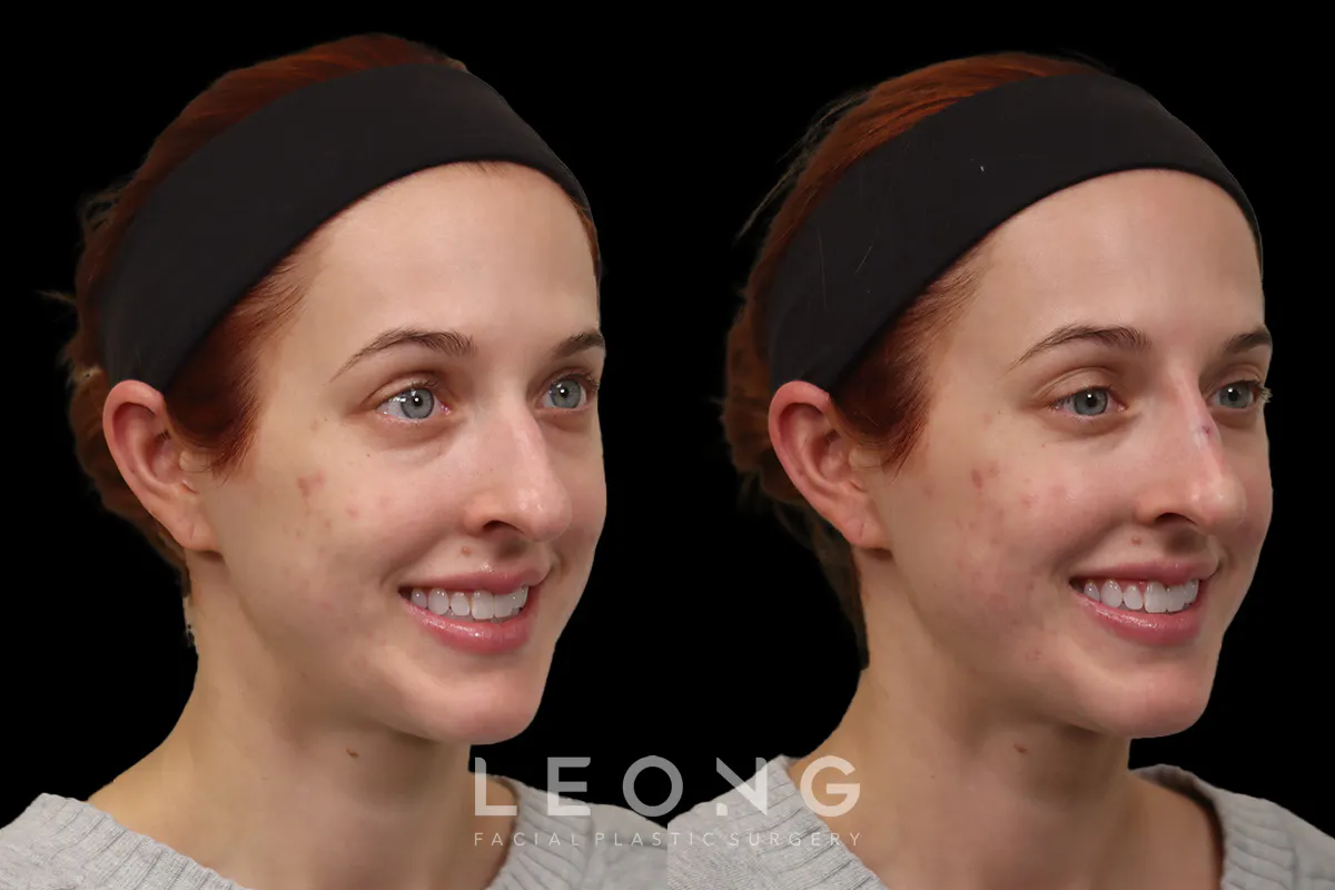 Nose Before and After | Leong Facial Plastic Surgery