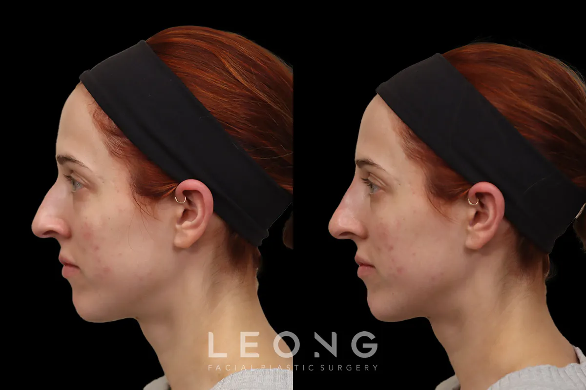 Nose Before and After | Leong Facial Plastic Surgery