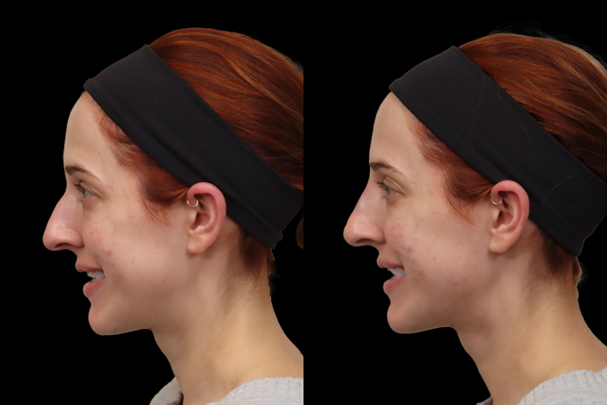 Nose Before and After | Leong Facial Plastic Surgery