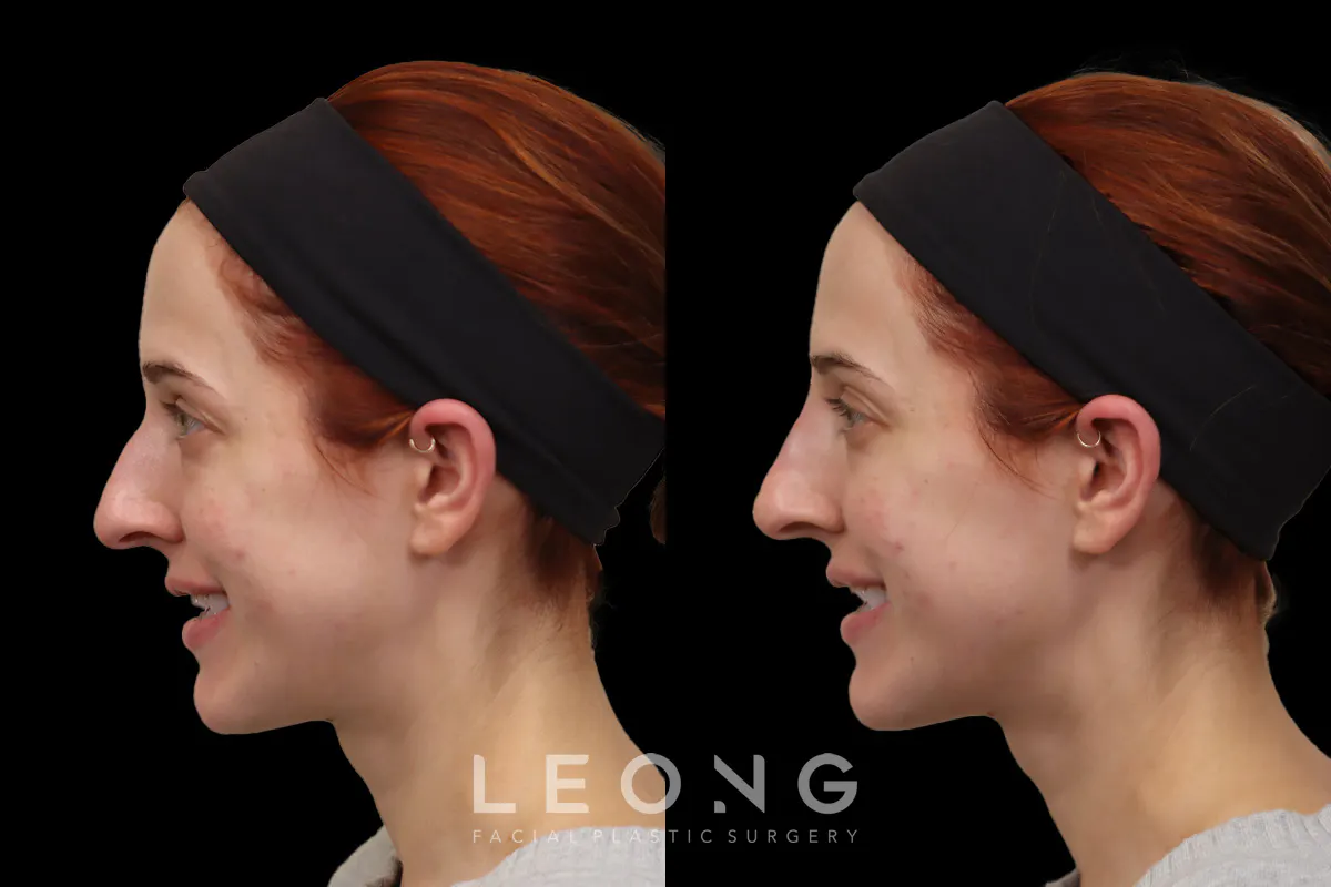 Nose Before and After | Leong Facial Plastic Surgery
